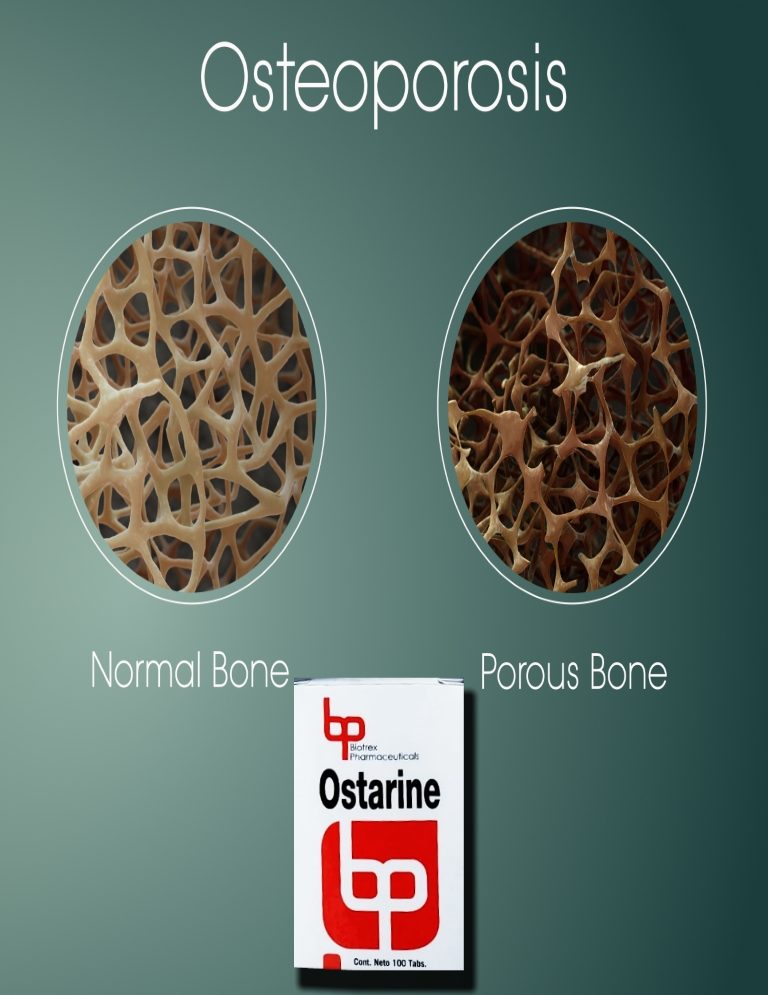 Lee más sobre el artículo Ostarine MK-2866 Y Osteoporosis